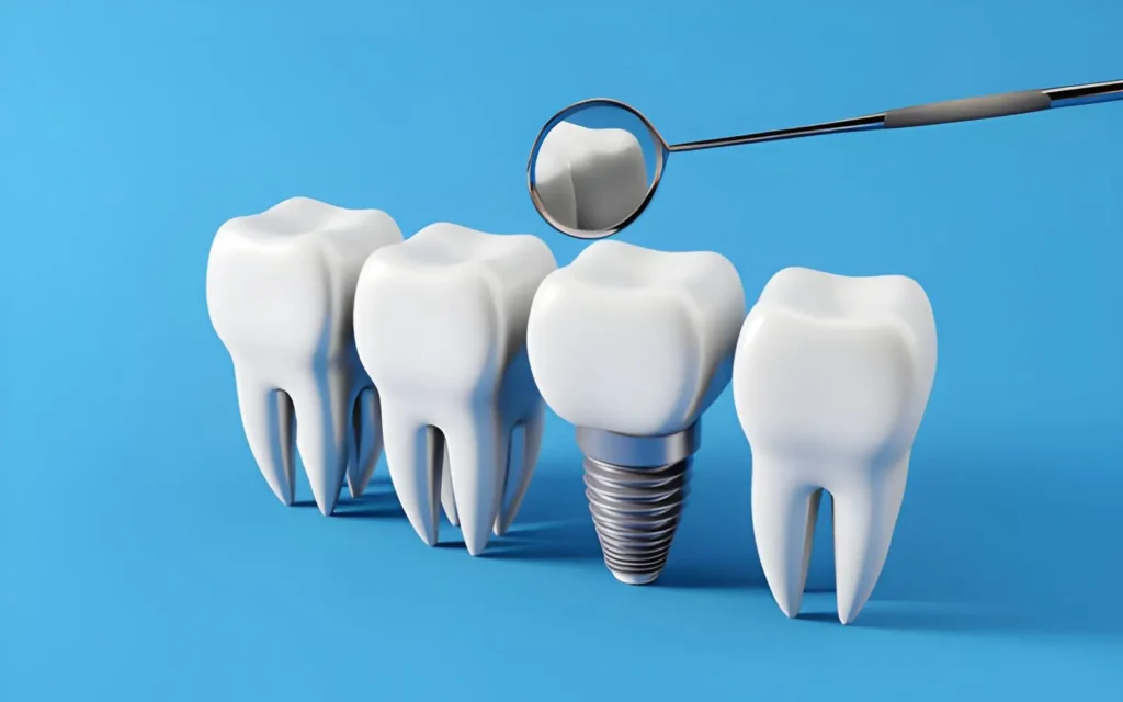 What to Expect From a Dental Implant Procedure in White Rock