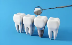 Read more about the article What to Expect From a Dental Implant Procedure in White Rock