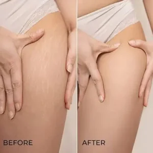 Read more about the article Effective Cellulite Treatment: How Elite Body Contouring Transforms Skin Smoothness