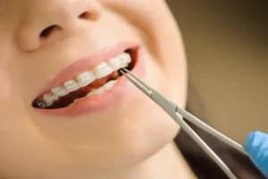 Read more about the article Reasons Parents Choose Clear Braces In South Surrey For Teenagers