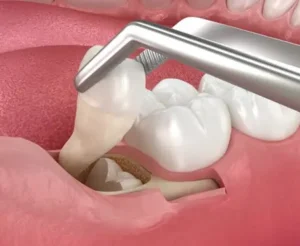 Read more about the article A Clear Look at Wisdom Teeth and Modern Removal Care