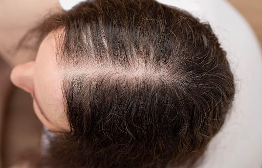 4 Easy Ways To Fix Thinning Hair