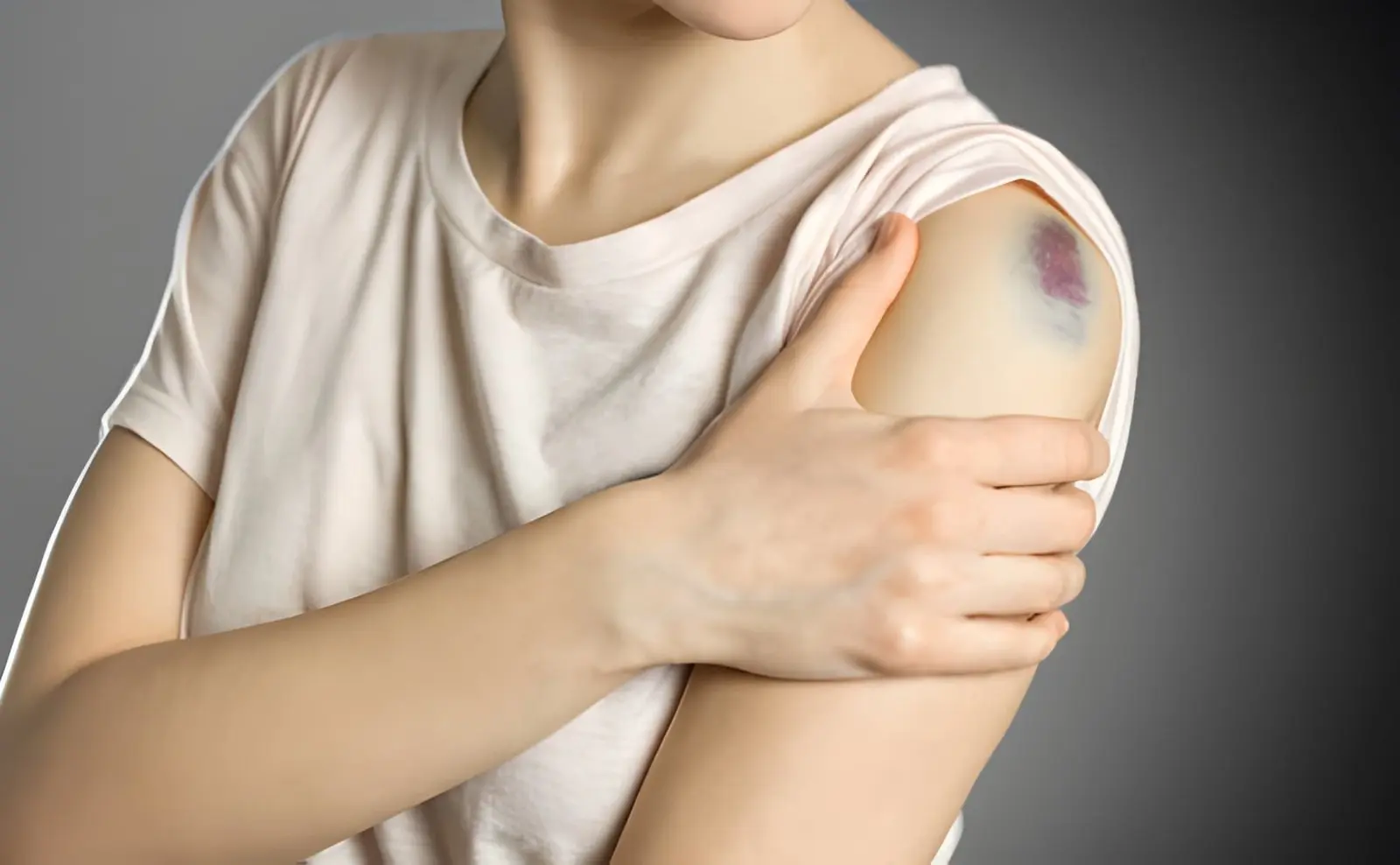 Read more about the article Do People Bruise More Easily After Cosmetic Injectables