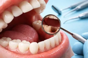 Read more about the article The Tooth Replacement That Quietly Becomes Part of Who You Are