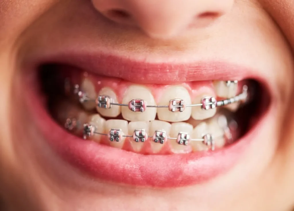 Why Patients Trust Experienced Orthodontists in Johns Creek