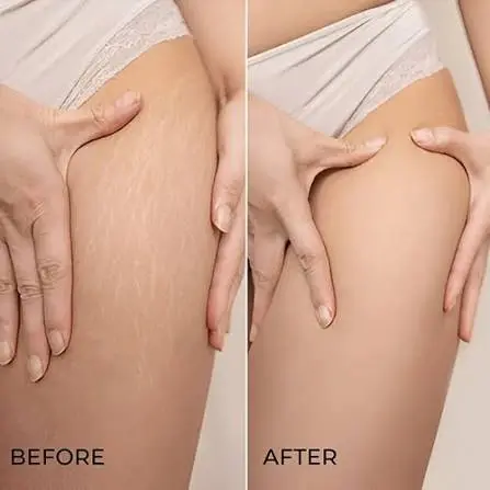 Effective Cellulite Treatment: How Elite Body Contouring Transforms Skin Smoothness