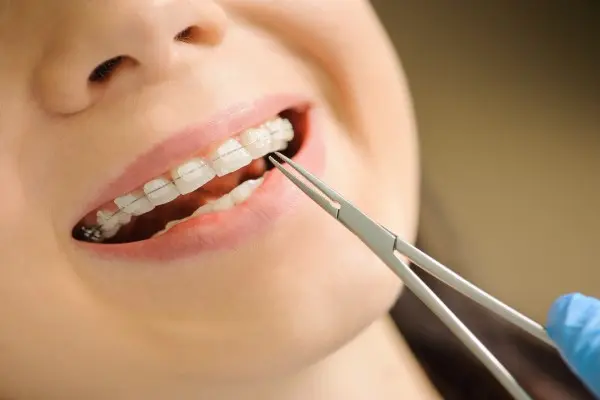 Reasons Parents Choose Clear Braces In South Surrey For Teenagers
