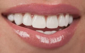 Read more about the article Who Benefits Most From Porcelain Veneers in Kitchener
