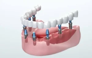Read more about the article Dental Implants in Rockville, MD: Transforming Smiles and Lives