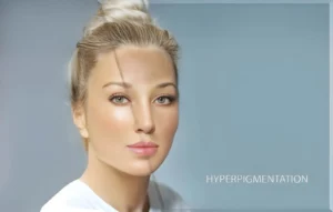 Read more about the article Skincare for Hyperpigmentation: Effective Strategies and Solutions