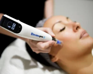 Read more about the article Unlocking Radiant Skin: The Benefits of Microneedling in Canberra