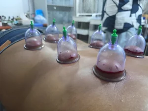 Read more about the article Unlock the Healing Power of Cupping Therapy with Our Online Hijama Course
