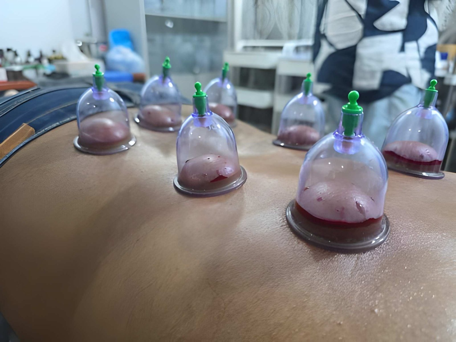 Read more about the article Unlock the Healing Power of Cupping Therapy with Our Online Hijama Course